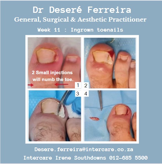 Ingrown toenail removal